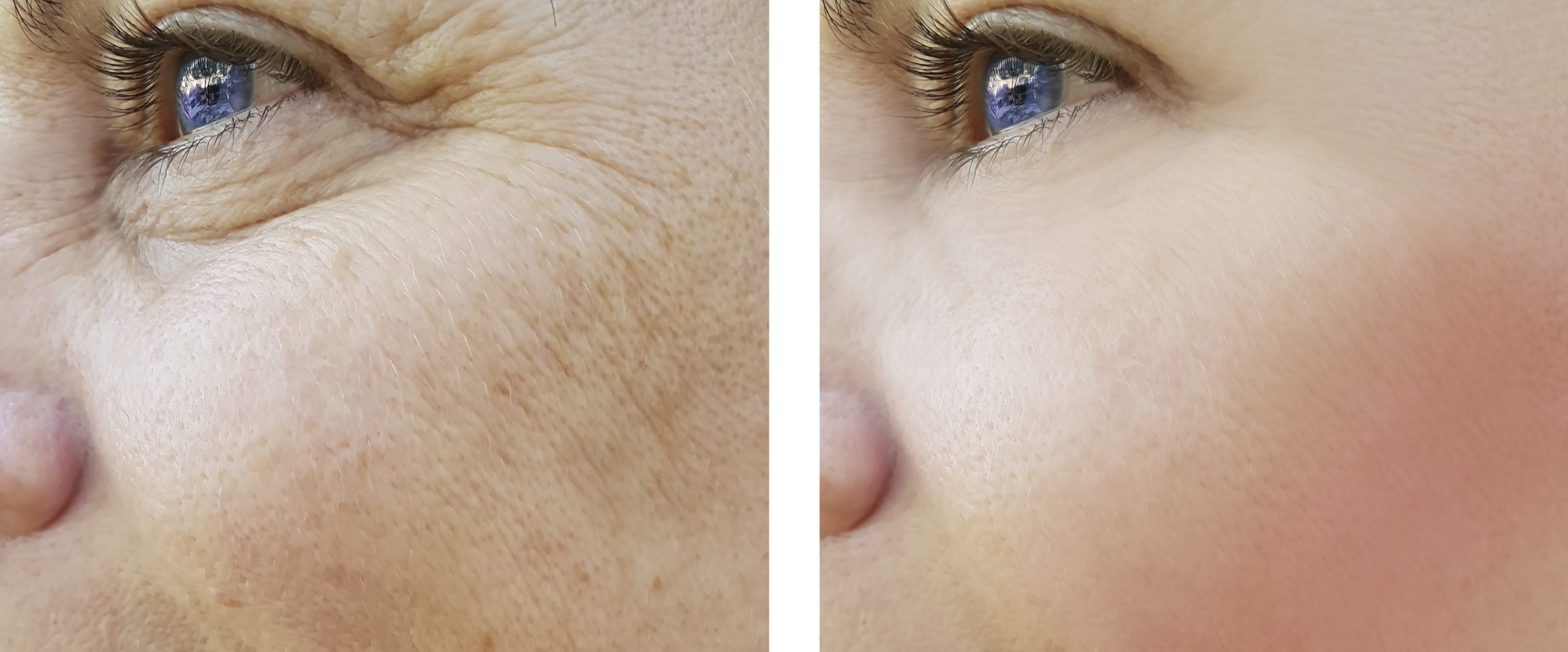 IPL Pigmentation Therapy