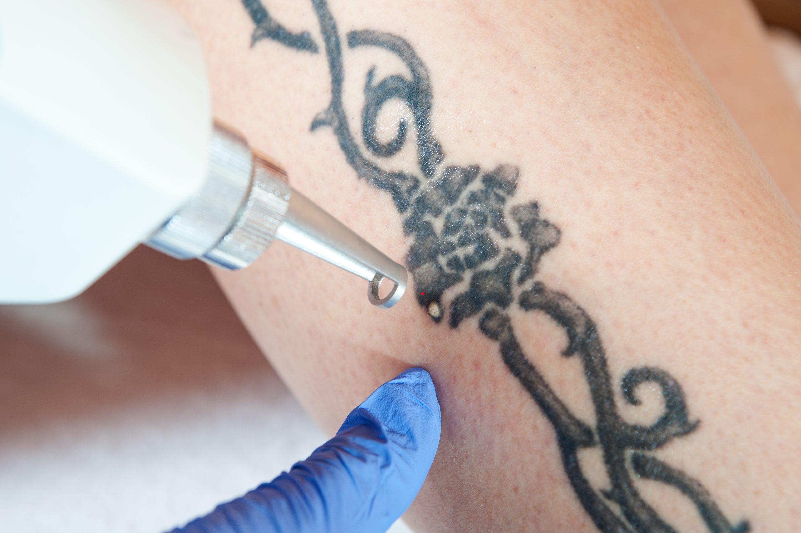 ND Yag Laser Tattoo Removal