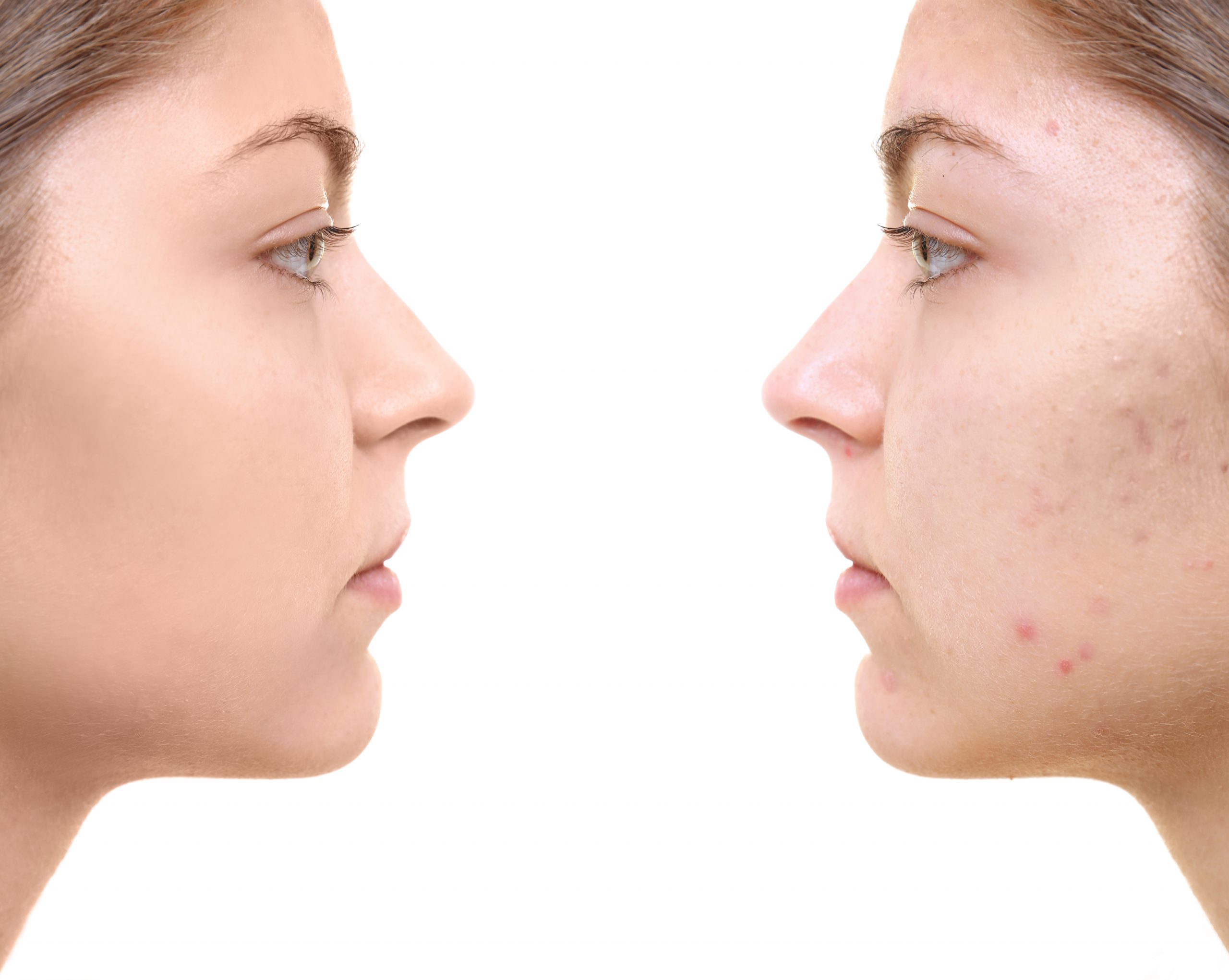 ND Yag Non-Ablative Skin Resurfacing (deep wrinkles and acne scars)