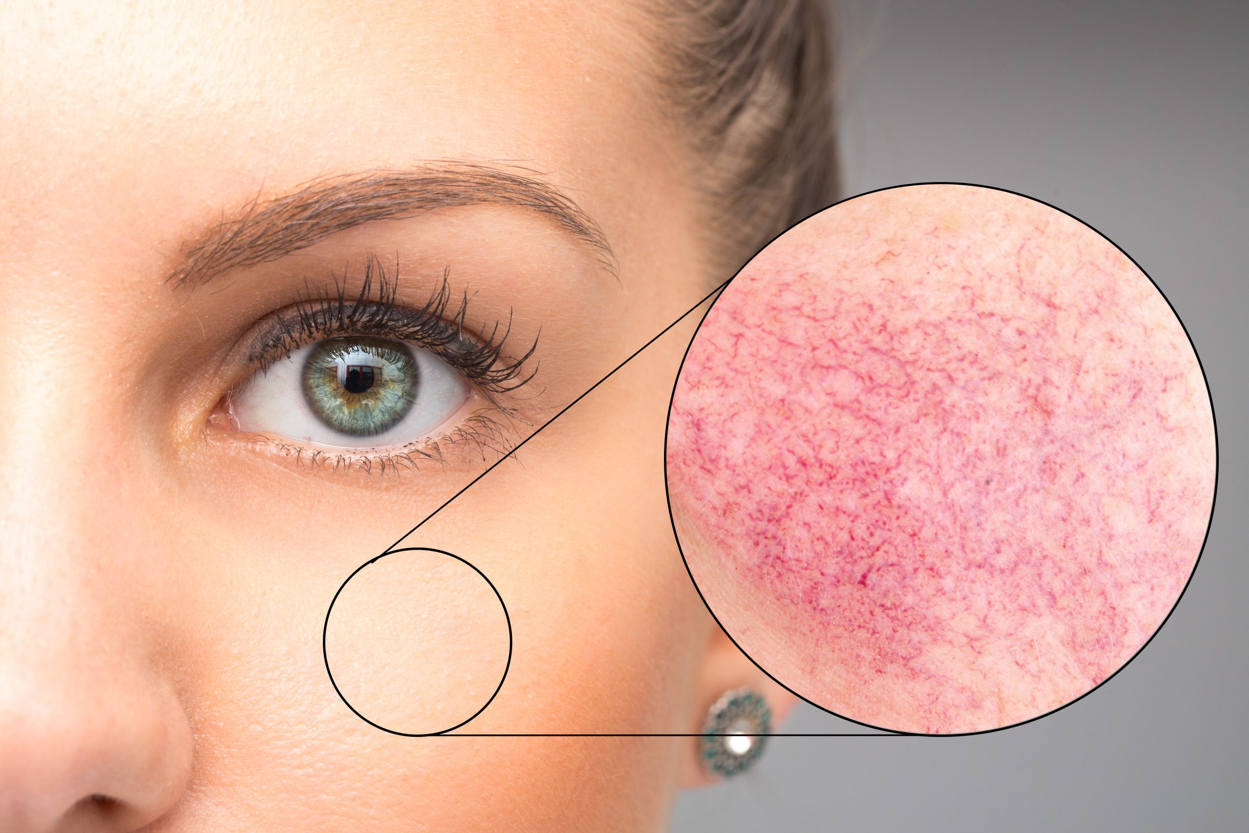 Rosacea IPL Therapy